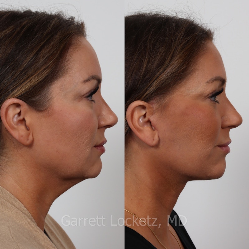 Deep Plane Facelift Before & After Gallery - Patient 197503140 - Image 1
