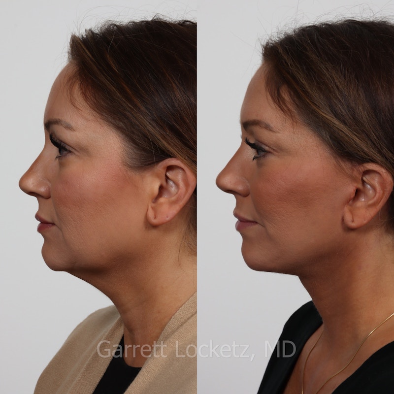 Deep Plane Facelift Before & After Gallery - Patient 197503141 - Image 1