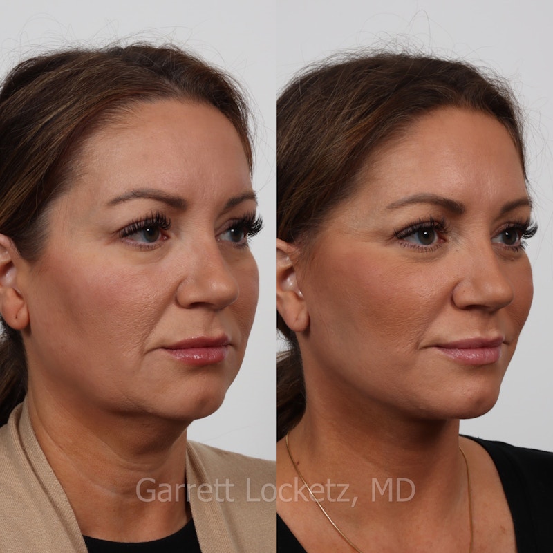 Deep Plane Facelift Before & After Gallery - Patient 197503142 - Image 1