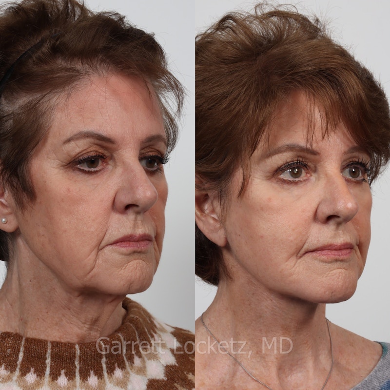 Deep Plane Facelift Before & After Gallery - Patient 197503143 - Image 1
