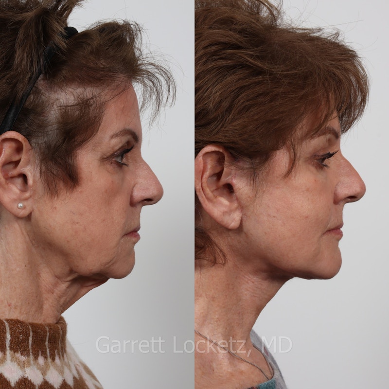 Deep Plane Facelift Before & After Gallery - Patient 197503144 - Image 1