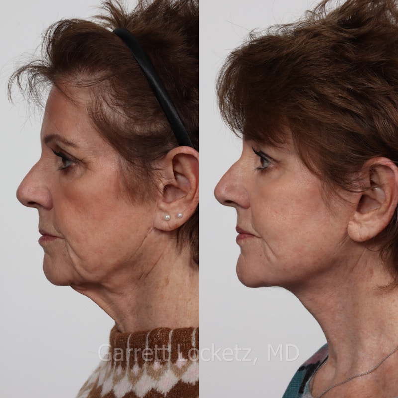 Deep Plane Facelift Before & After Gallery - Patient 197503145 - Image 1