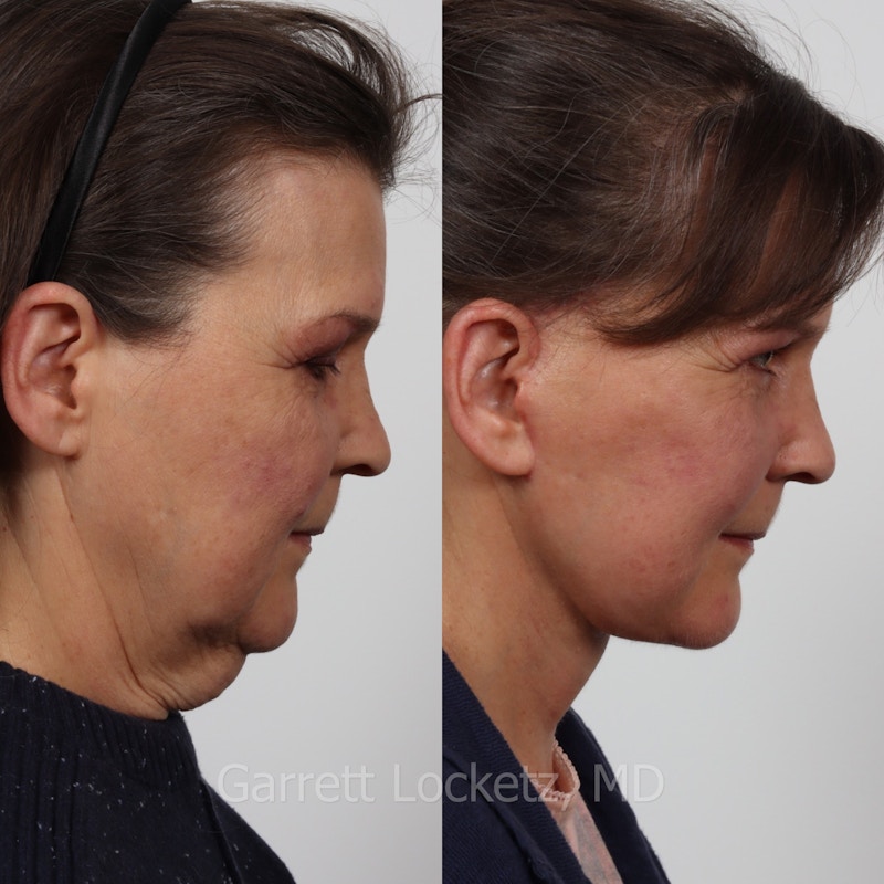 Deep Plane Facelift Before & After Gallery - Patient 197503146 - Image 1