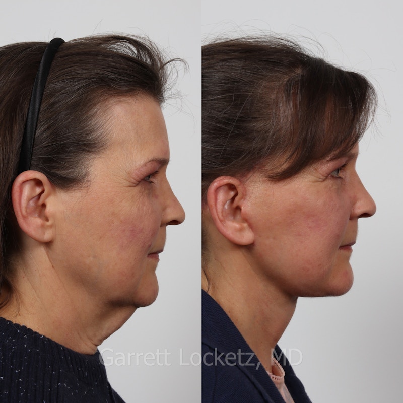 Deep Plane Facelift Before & After Gallery - Patient 197503147 - Image 1