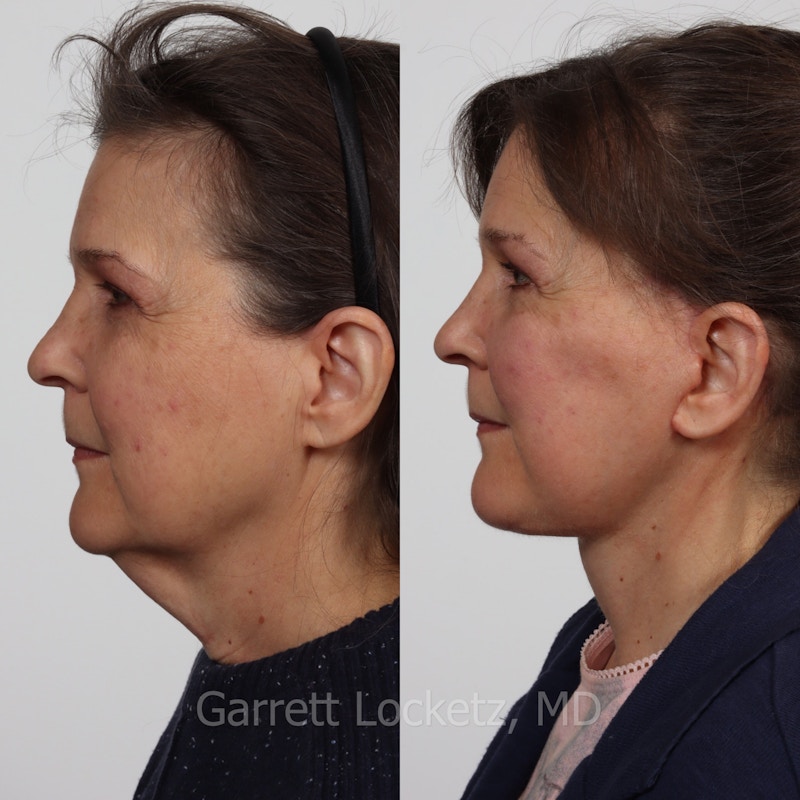 Deep Plane Facelift Before & After Gallery - Patient 197503148 - Image 1