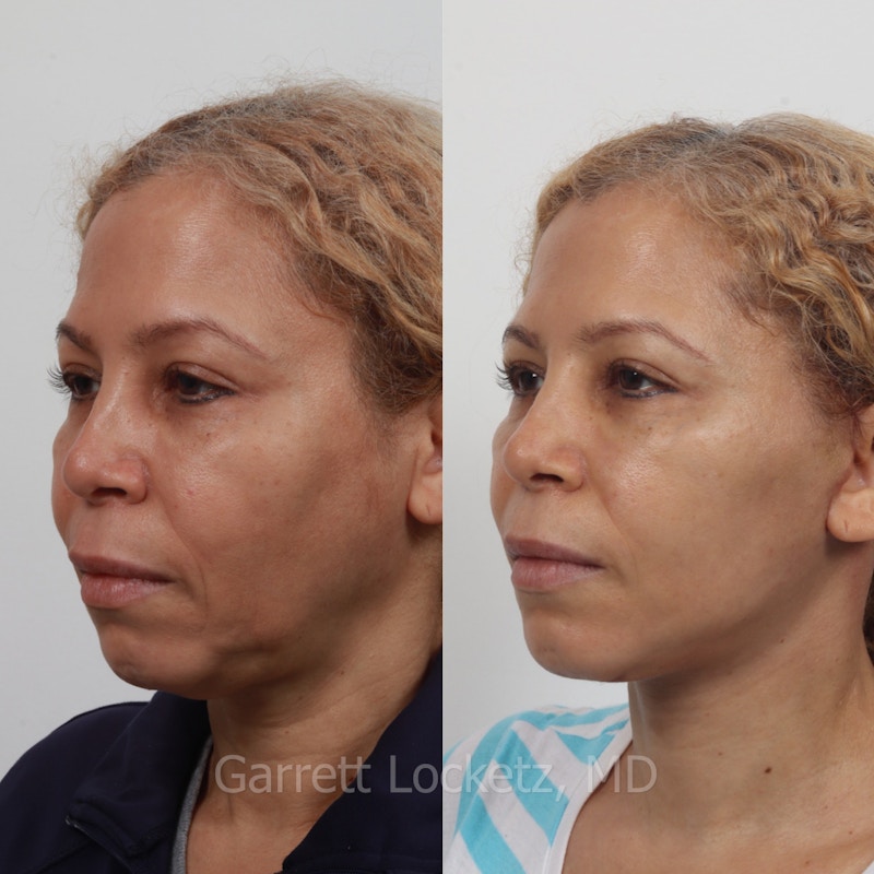 Deep Plane Facelift Before & After Gallery - Patient 197503149 - Image 1