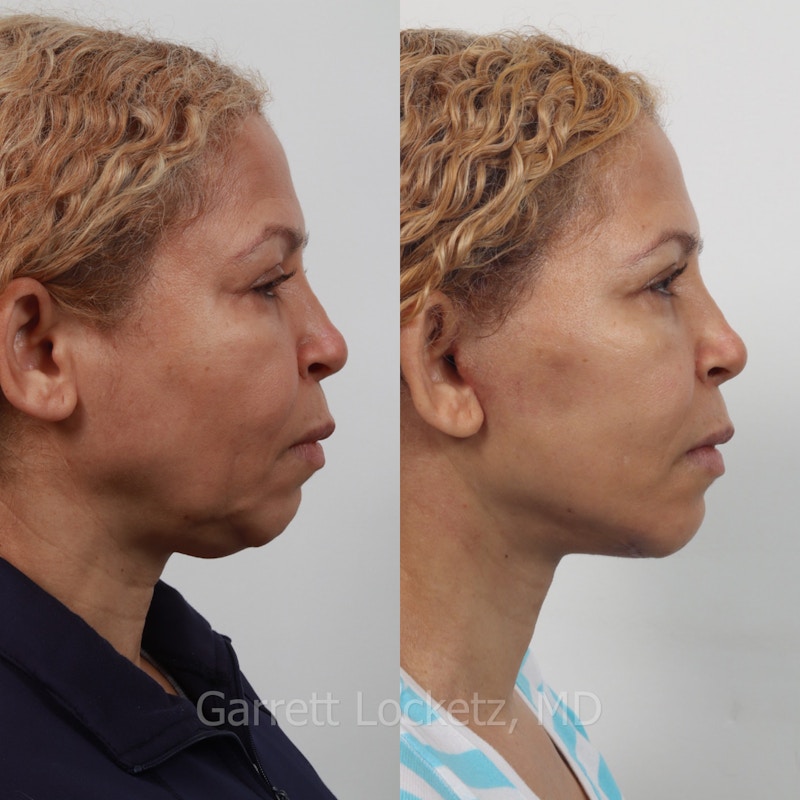 Deep Plane Facelift Before & After Gallery - Patient 197503150 - Image 1