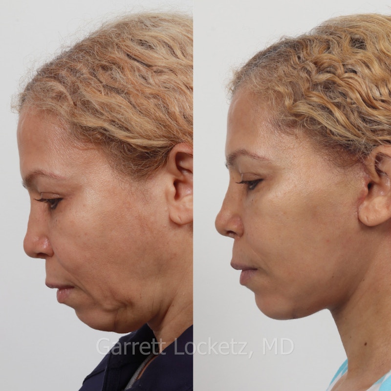 Deep Plane Facelift Before & After Gallery - Patient 197503151 - Image 1