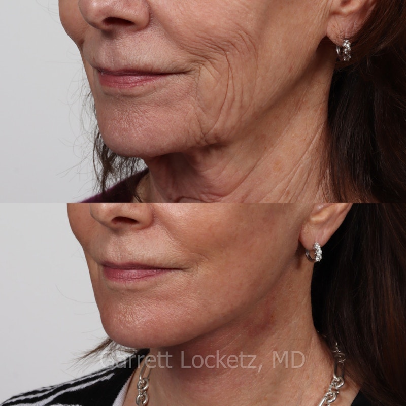 Deep Plane Facelift Before & After Gallery - Patient 197503152 - Image 1
