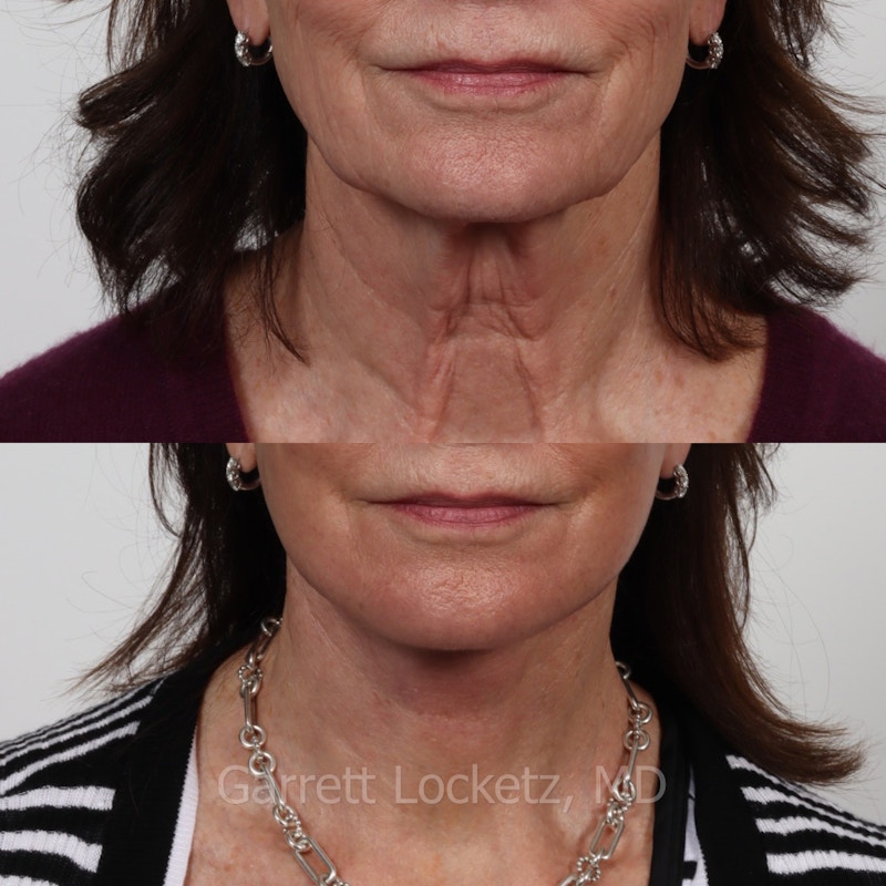 Deep Plane Facelift Before & After Gallery - Patient 197503153 - Image 1