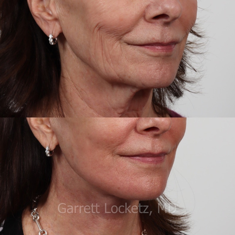Deep Plane Facelift Before & After Gallery - Patient 197503154 - Image 1