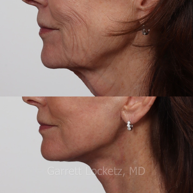 Deep Plane Facelift Before & After Gallery - Patient 197503155 - Image 1