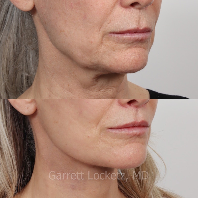 Deep Plane Facelift Before & After Gallery - Patient 197503156 - Image 1