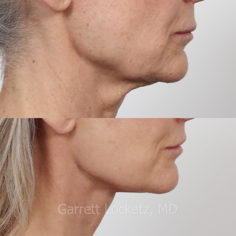 Deep Plane Facelift Before & After Gallery - Patient 197503157 - Image 1