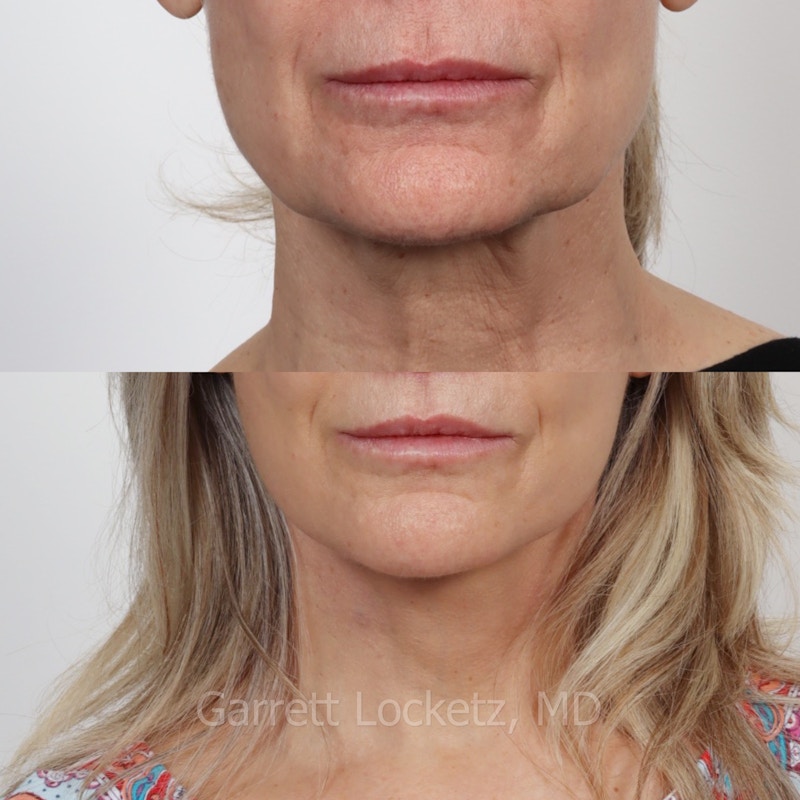 Deep Plane Facelift Before & After Gallery - Patient 197503158 - Image 1
