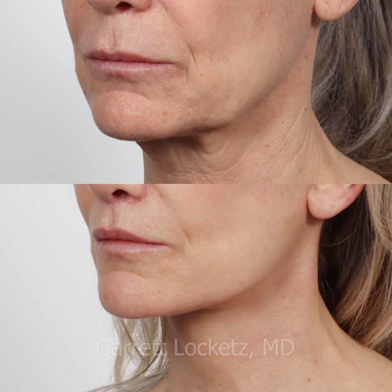 Deep Plane Facelift Before & After Gallery - Patient 197503159 - Image 1