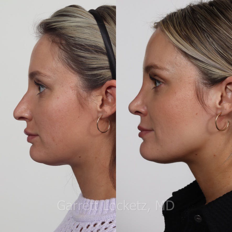 Rhinoplasty Before & After Gallery - Patient 197505939 - Image 1
