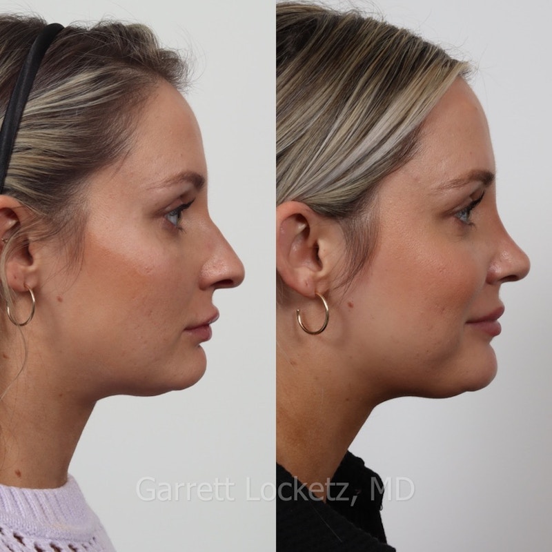 Rhinoplasty Before & After Gallery - Patient 197505940 - Image 1