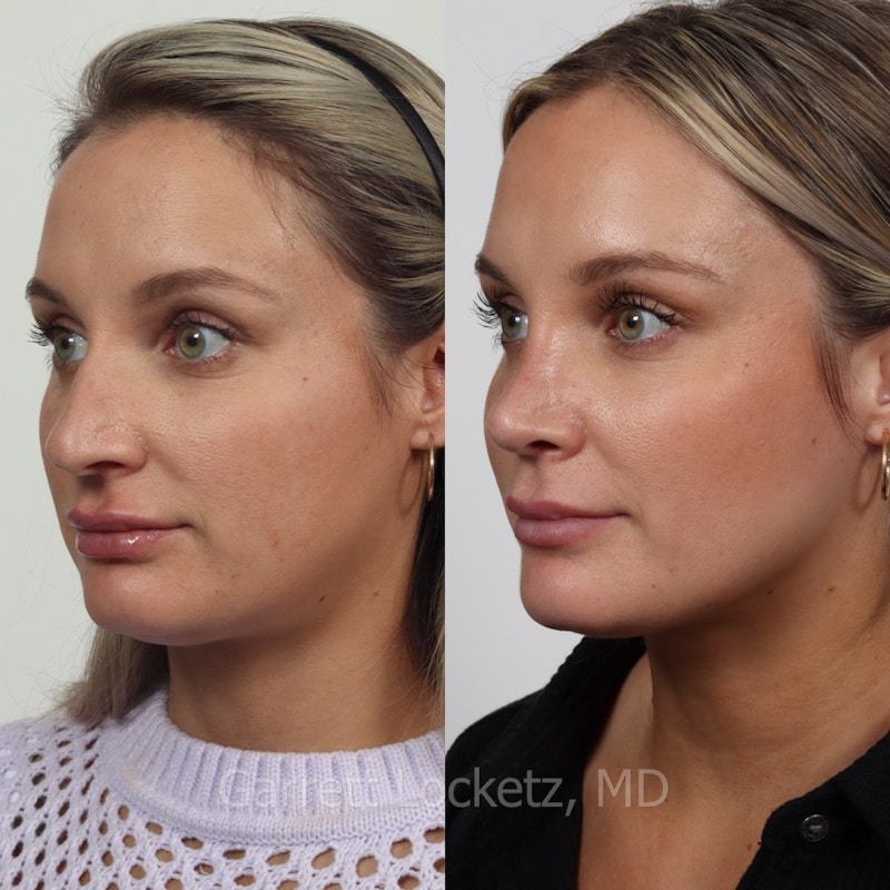 Rhinoplasty Before & After Gallery - Patient 197505941 - Image 1