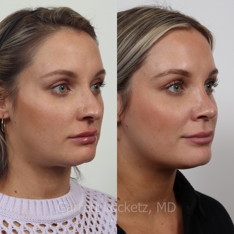 Rhinoplasty Before & After Gallery - Patient 197505942 - Image 1