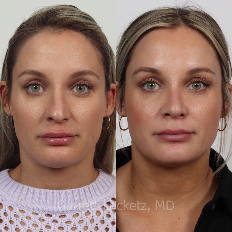 Rhinoplasty Before & After Gallery - Patient 197505943 - Image 1