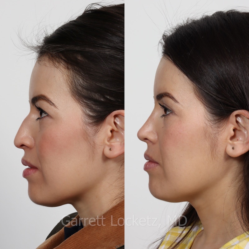 Rhinoplasty Before & After Gallery - Patient 197505944 - Image 1