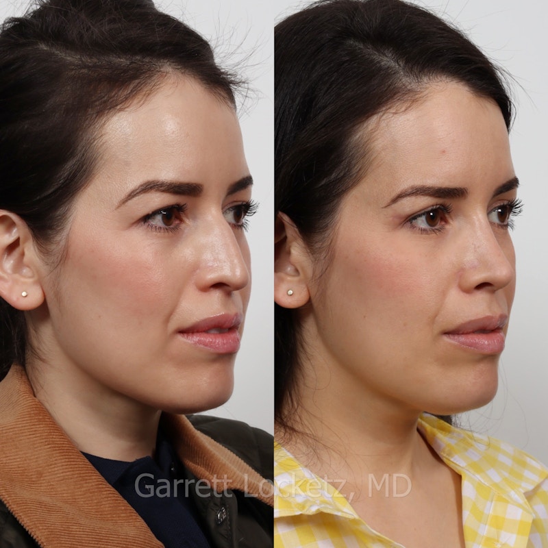 Rhinoplasty Before & After Gallery - Patient 197505945 - Image 1