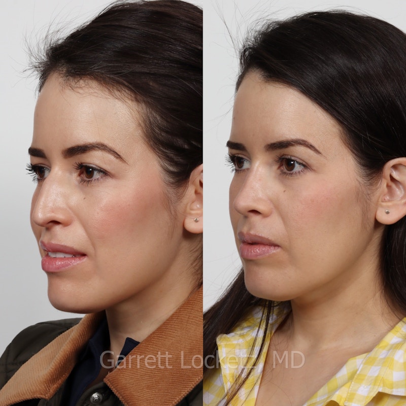 Rhinoplasty Before & After Gallery - Patient 197505946 - Image 1