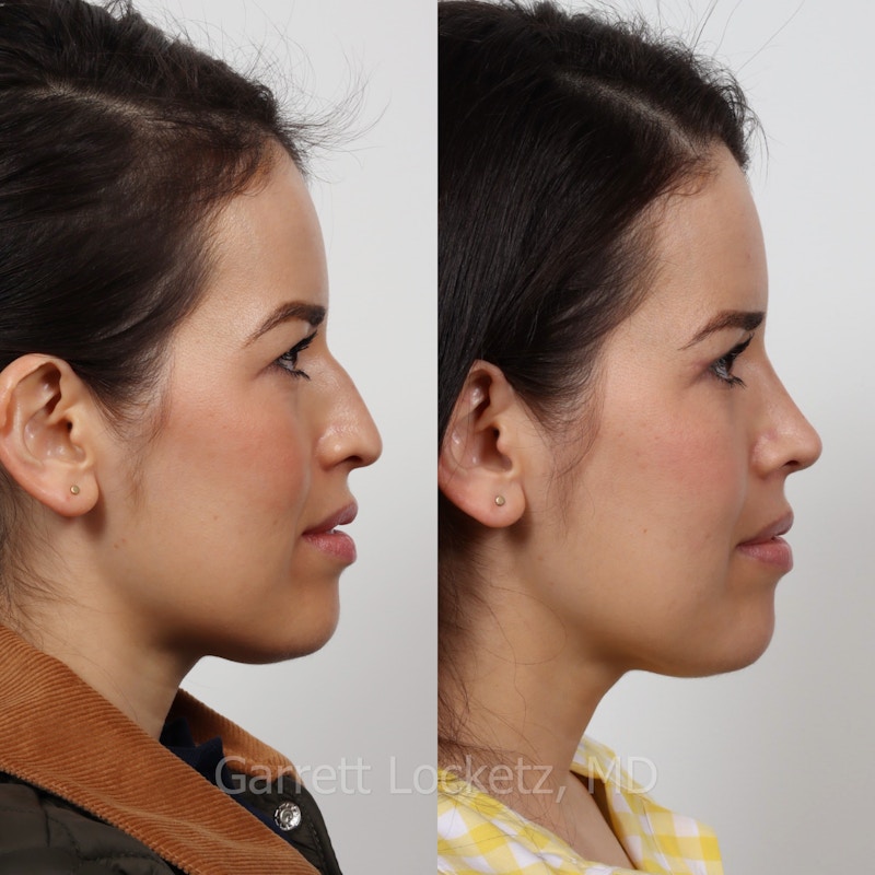 Rhinoplasty Before & After Gallery - Patient 197505947 - Image 1