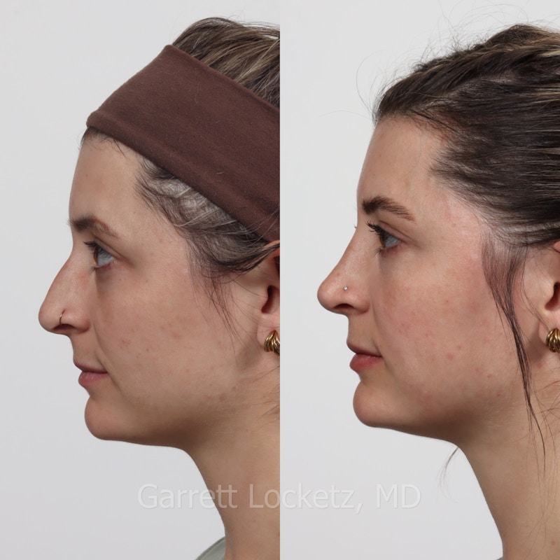 Rhinoplasty Before & After Gallery - Patient 197505948 - Image 1