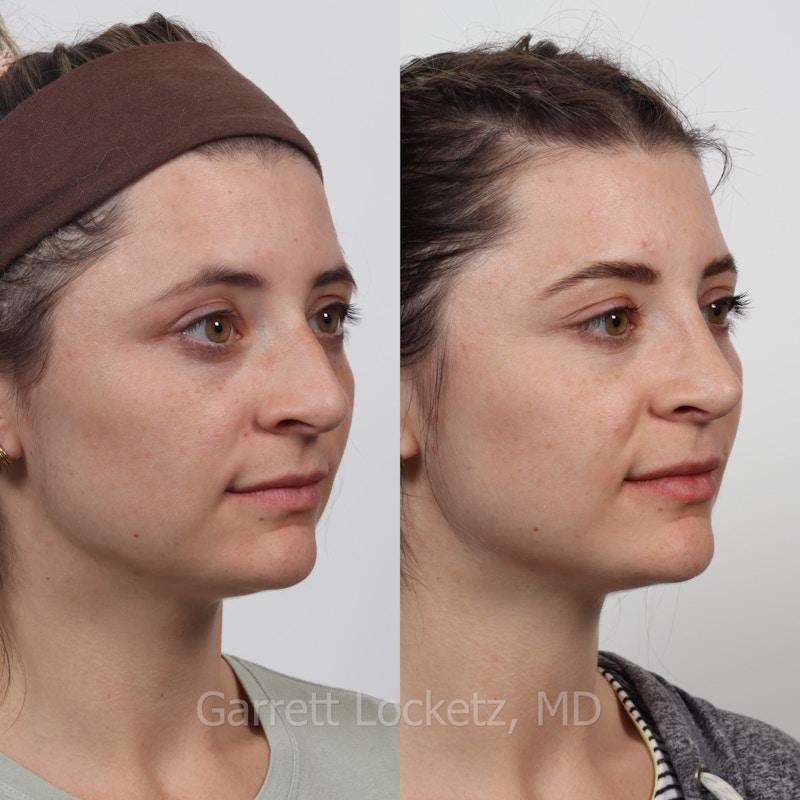 Rhinoplasty Before & After Gallery - Patient 197505950 - Image 1