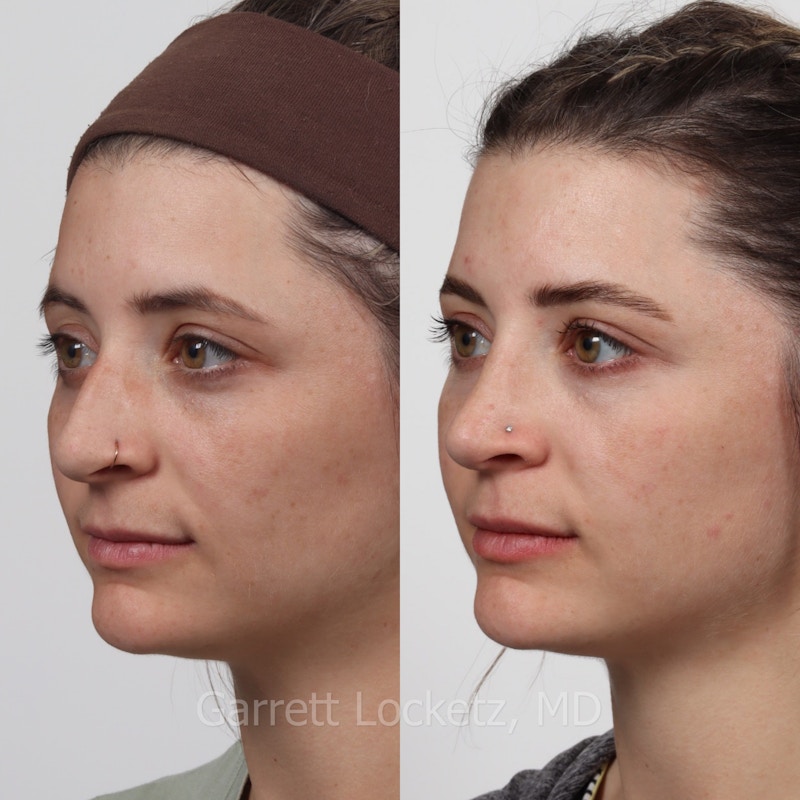 Rhinoplasty Before & After Gallery - Patient 197505951 - Image 1