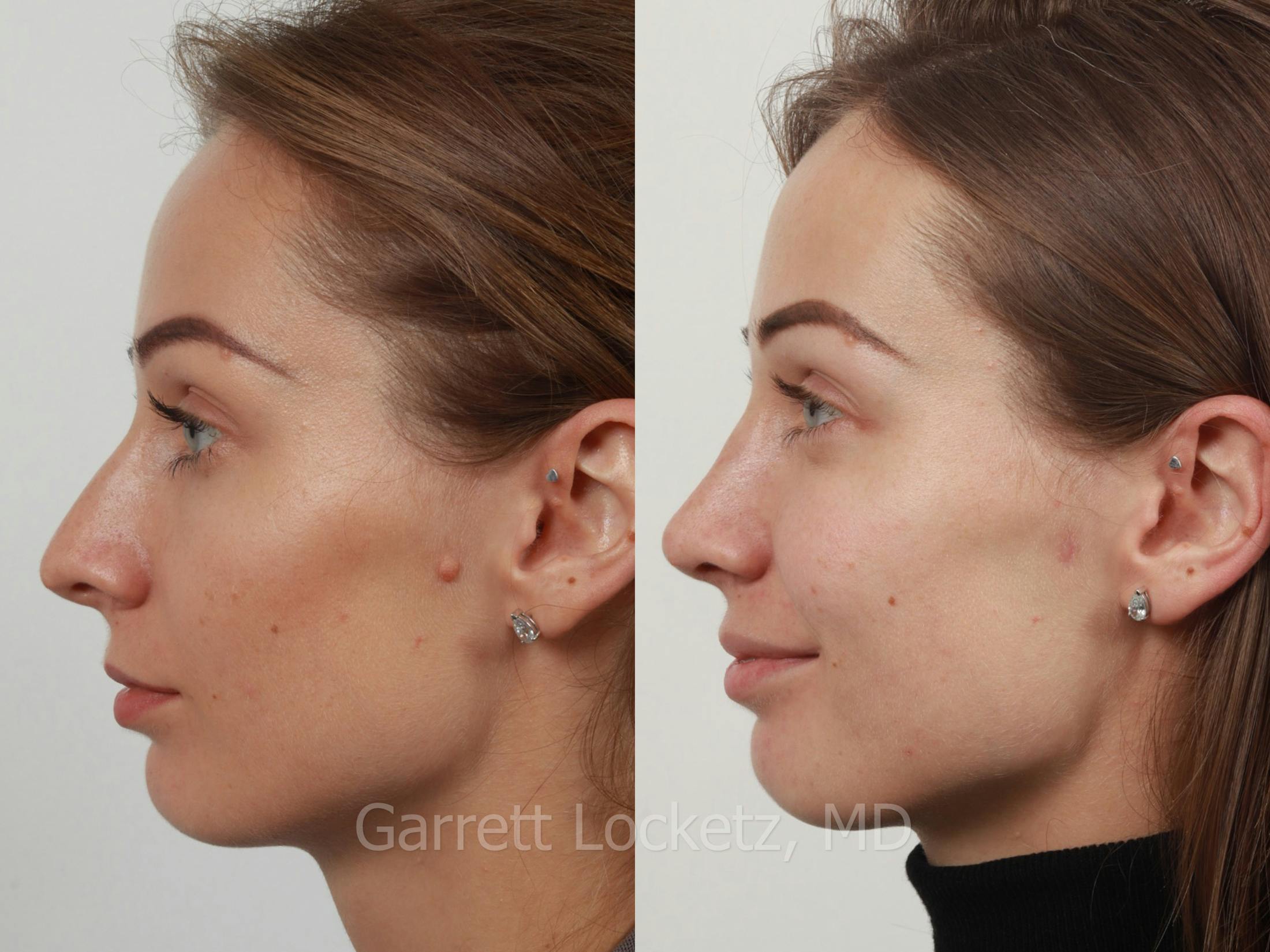Rhinoplasty Before & After Gallery - Patient 197505952 - Image 1
