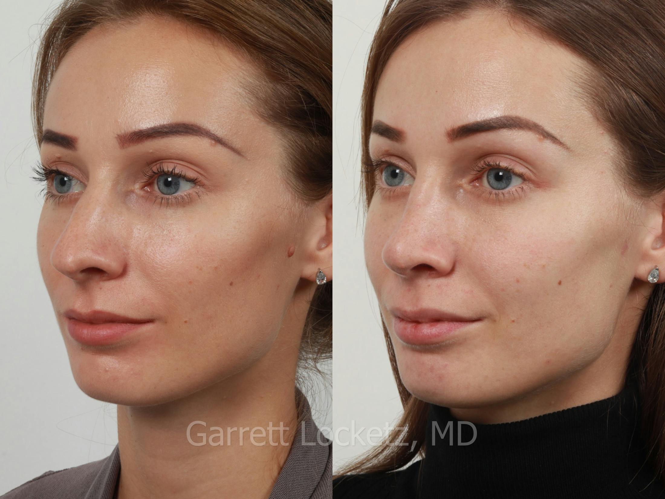 Rhinoplasty Before & After Gallery - Patient 197505954 - Image 1
