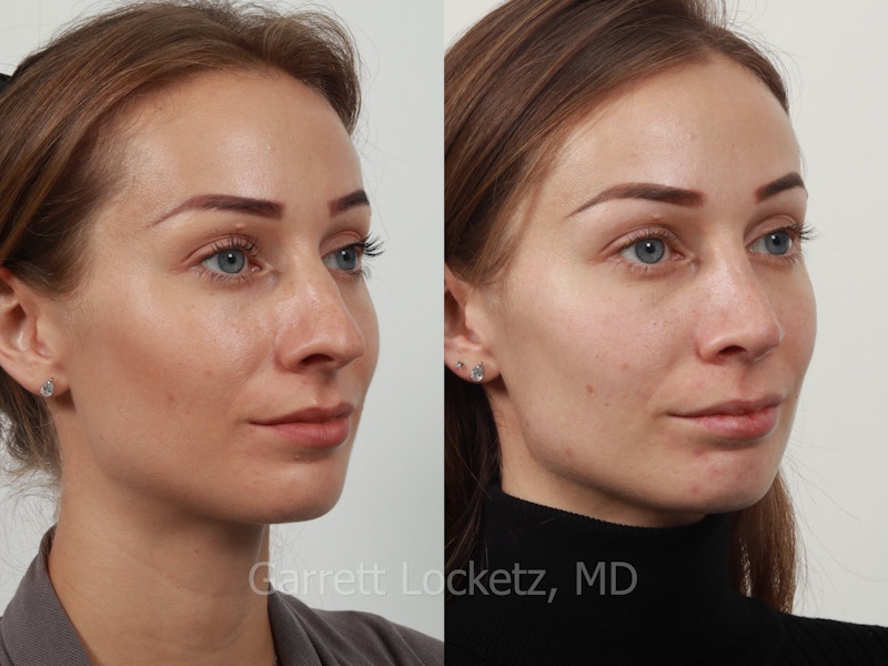 Rhinoplasty Before & After Gallery - Patient 197505955 - Image 1