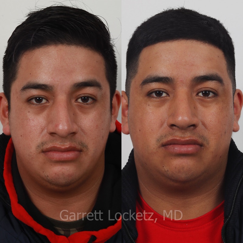Rhinoplasty Before & After Gallery - Patient 197505956 - Image 1