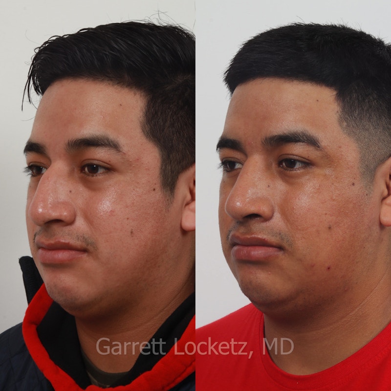 Rhinoplasty Before & After Gallery - Patient 197505957 - Image 1