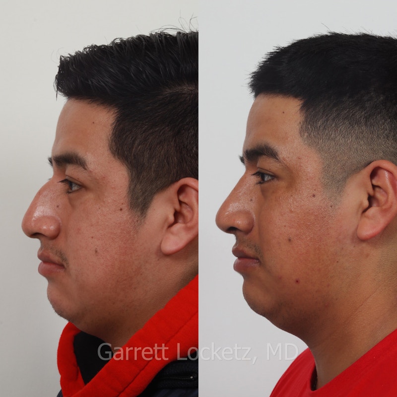 Rhinoplasty Before & After Gallery - Patient 197505958 - Image 1
