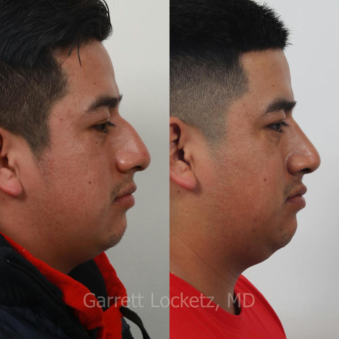 Rhinoplasty Before & After Gallery - Patient 197505959 - Image 1