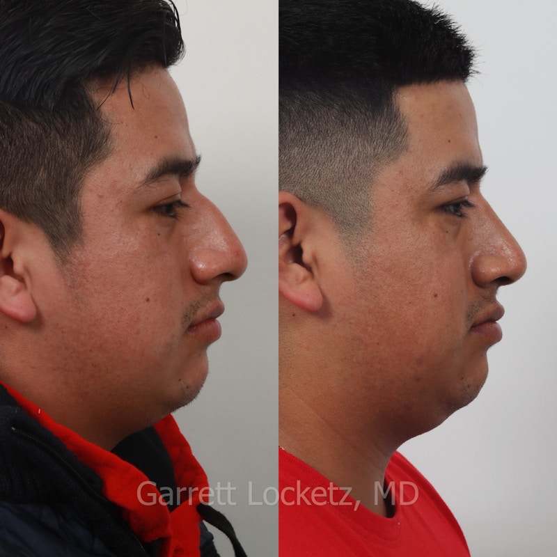 Rhinoplasty Before & After Gallery - Patient 197505959 - Image 1