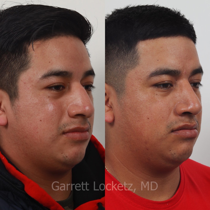 Rhinoplasty Before & After Gallery - Patient 197505960 - Image 1