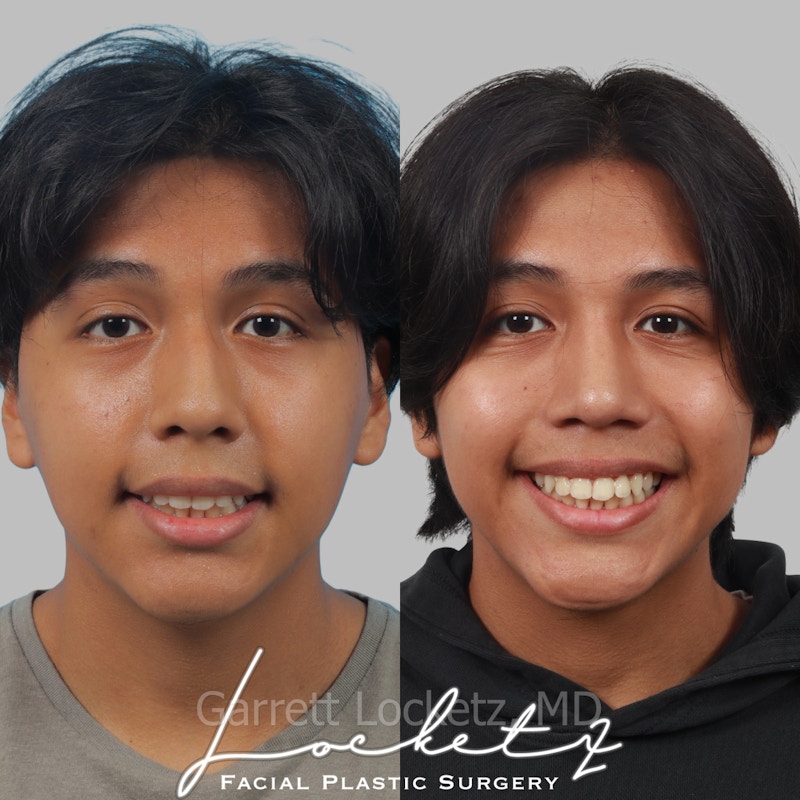 Rhinoplasty Before & After Gallery - Patient 197505961 - Image 1