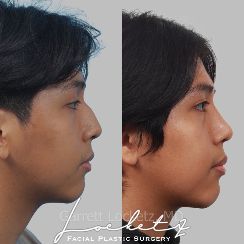 Rhinoplasty Before & After Gallery - Patient 197505962 - Image 1