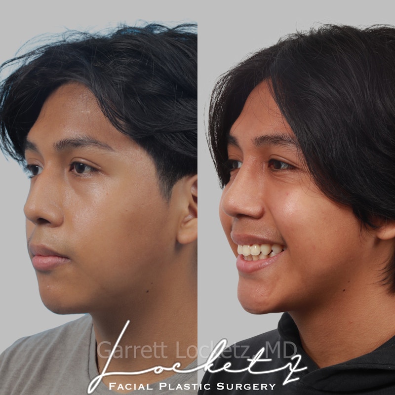 Rhinoplasty Before & After Gallery - Patient 197505963 - Image 1