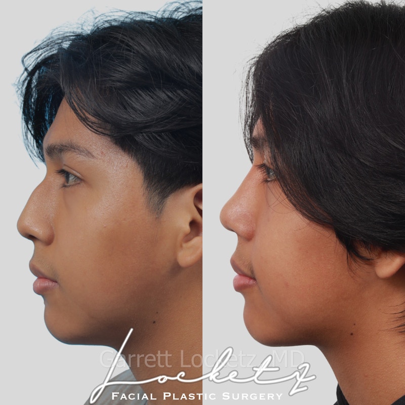 Rhinoplasty Before & After Gallery - Patient 197505964 - Image 1