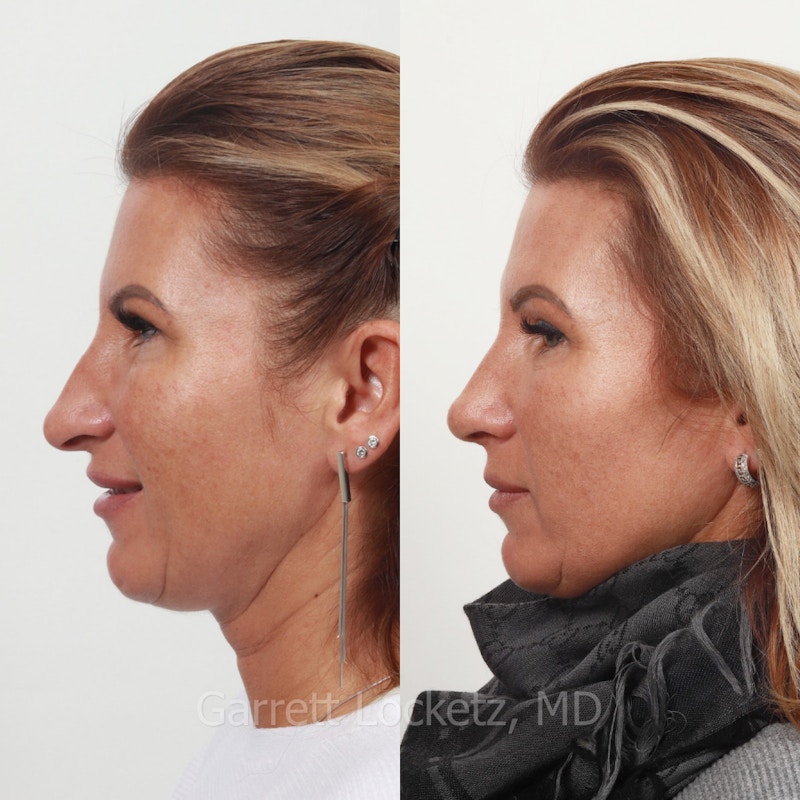 Rhinoplasty Before & After Gallery - Patient 197505965 - Image 1