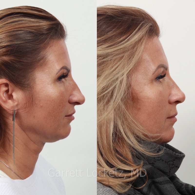 Rhinoplasty Before & After Gallery - Patient 197505966 - Image 1