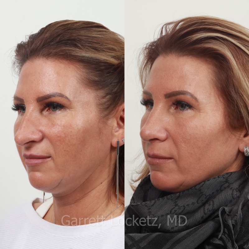 Rhinoplasty Before & After Gallery - Patient 197505967 - Image 1