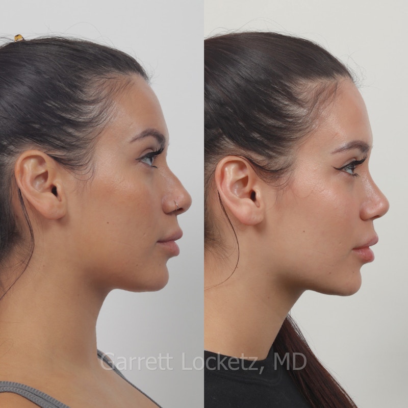 Rhinoplasty Before & After Gallery - Patient 197505968 - Image 1