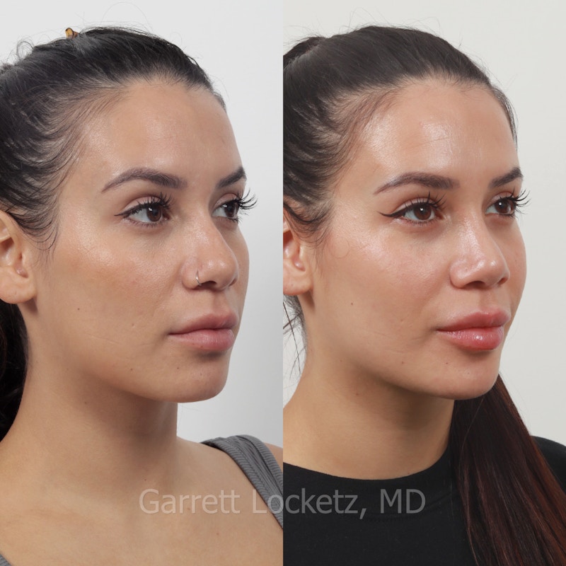 Rhinoplasty Before & After Gallery - Patient 197505969 - Image 1